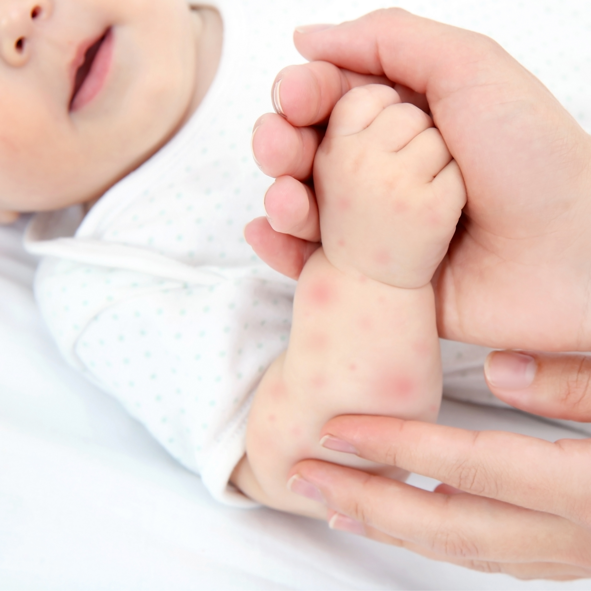 bebe plaques rouges peau 1-1